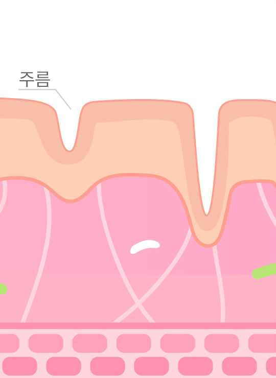 스컬트라 시술 스텝 1